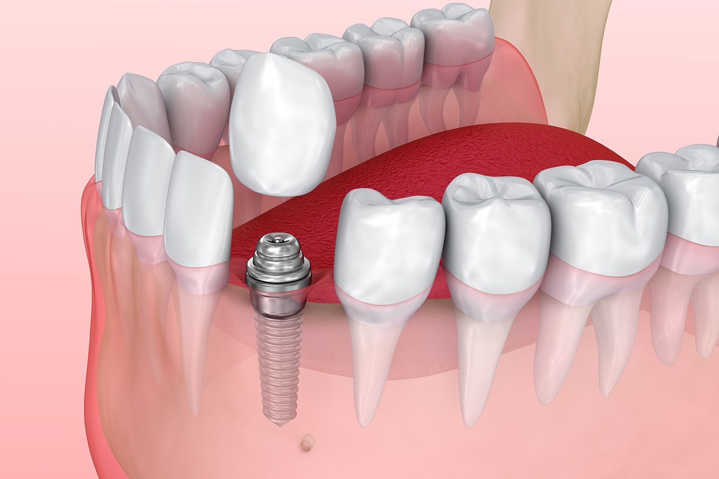 Dental implant in a jaw